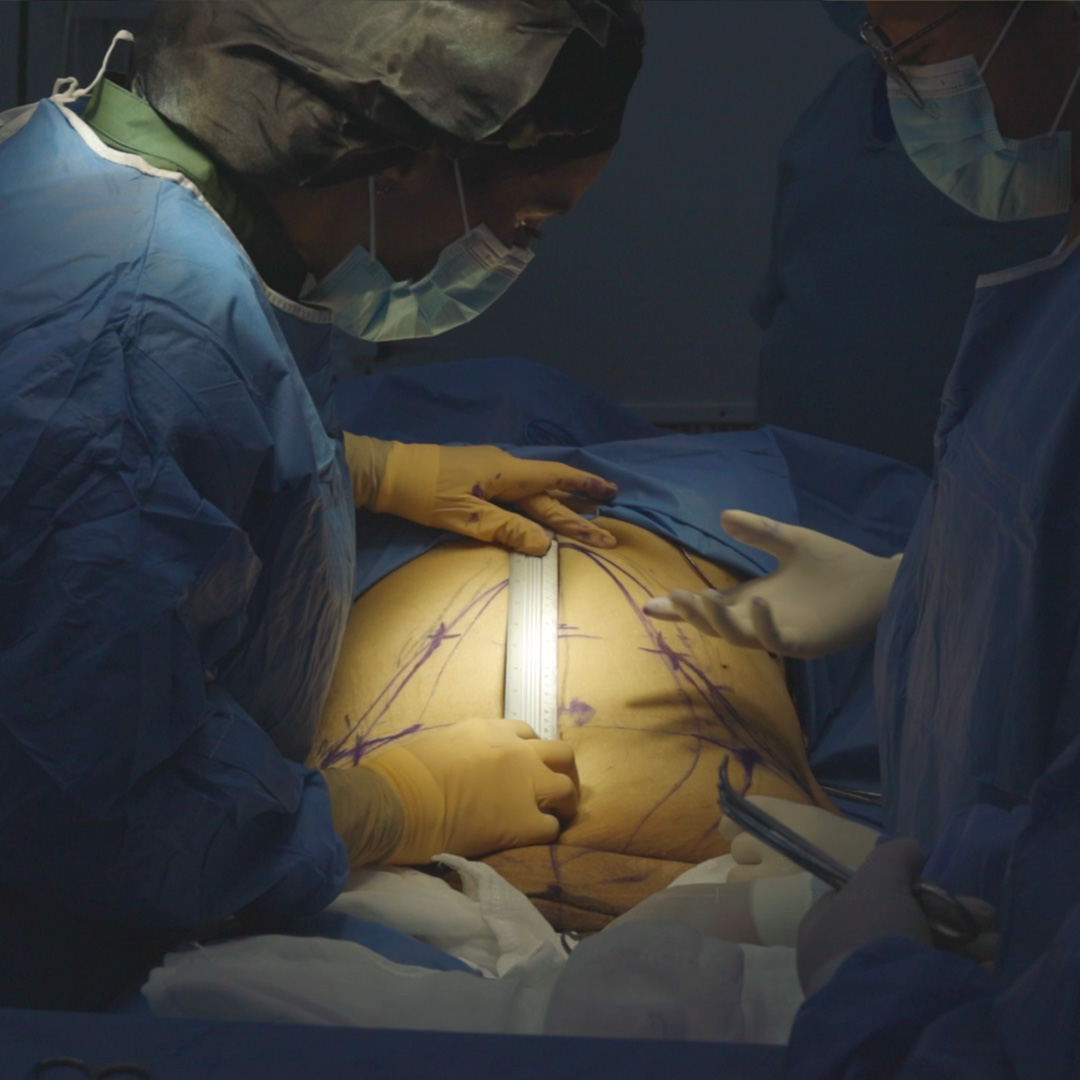 Abdominoplastia en flor de lis