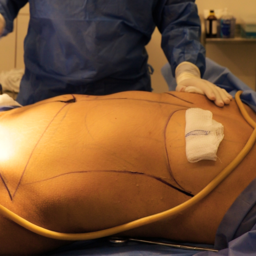 Abdominoplastiaextendida