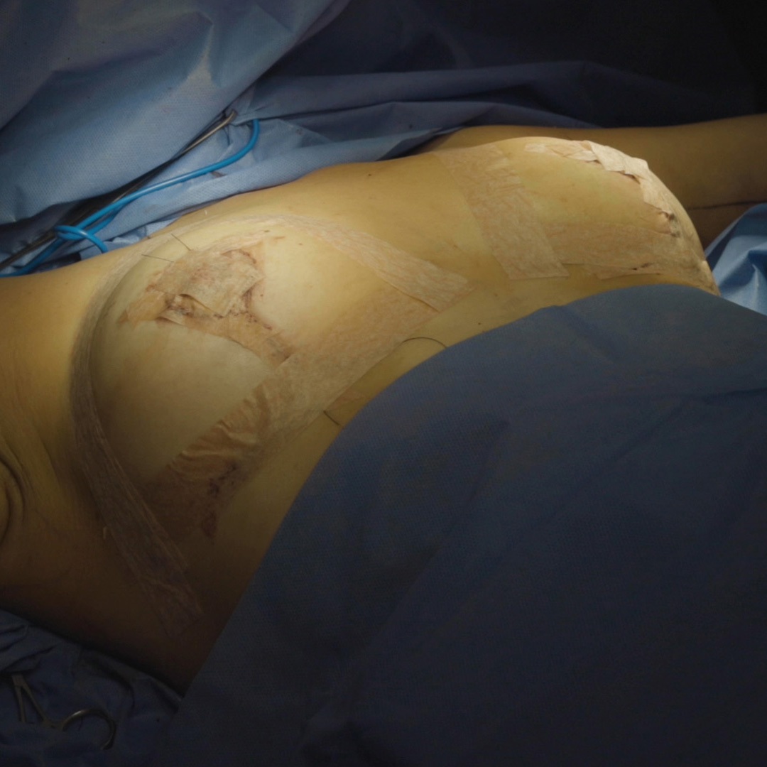 Aumento de senos con transferencia de grasa