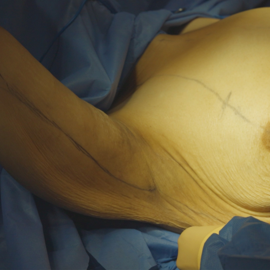 Braquioplastia extendida