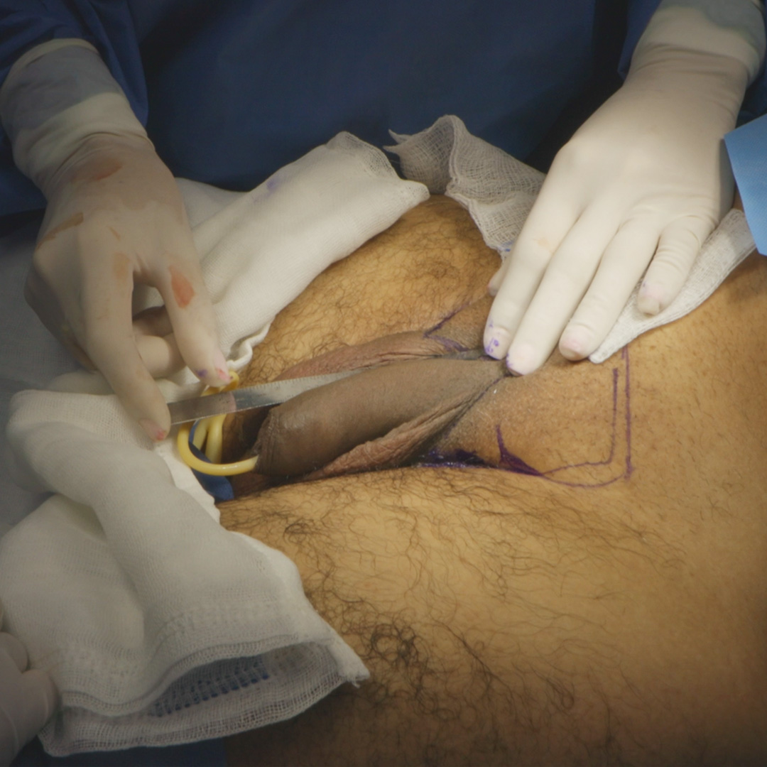 Faloplastia de Aumento