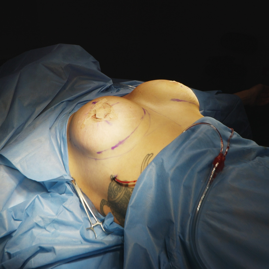 Levantamiento de senos con implantes