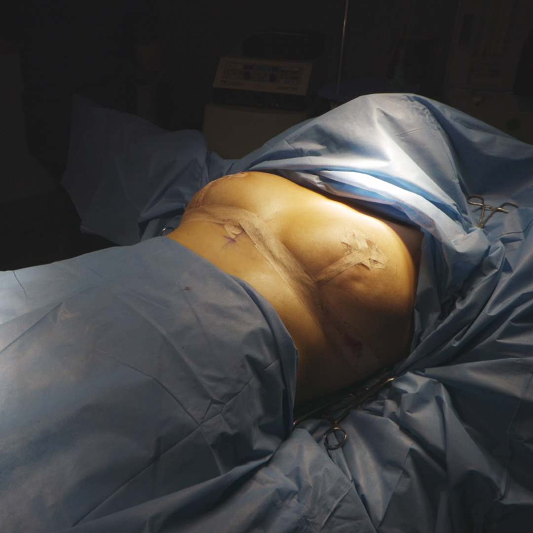 Levantamiento se senos sin implantes