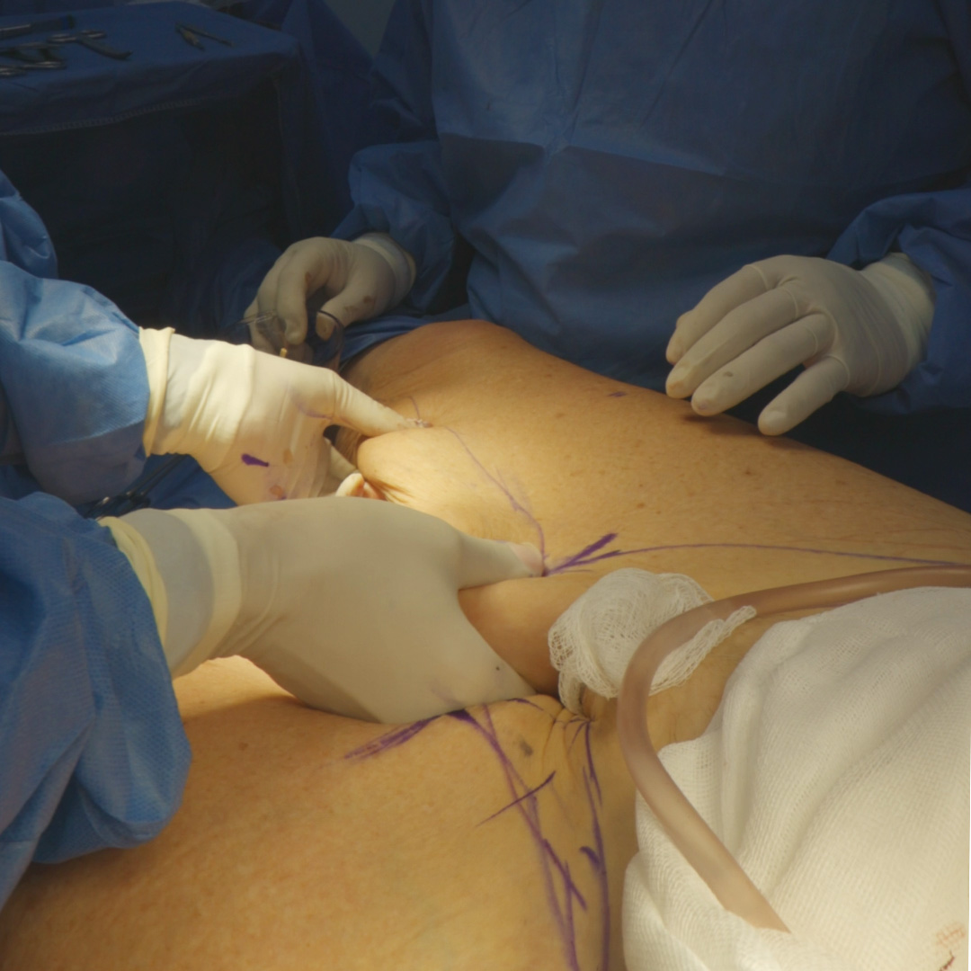 Liftingmedialdelmuslo