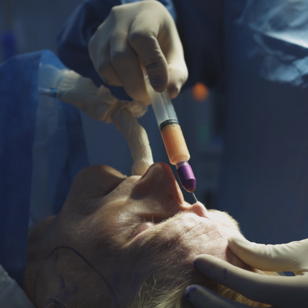 Transferencia de Grasa